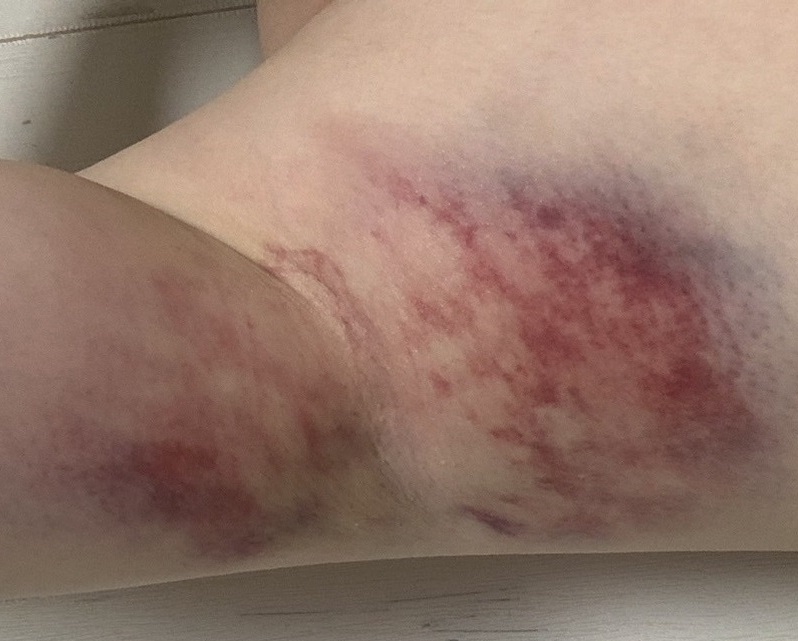 ミラドライ翌日