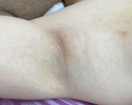 ミラドライ1ヶ月後