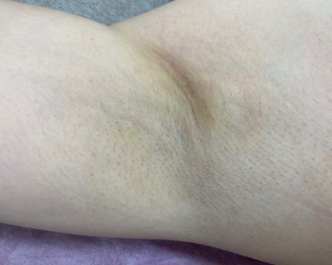 ミラドライ1週間後