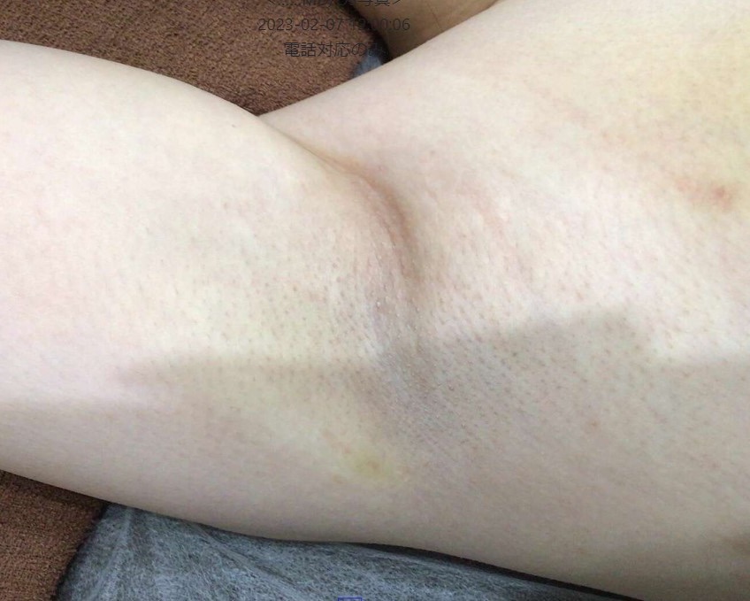 ミラドライ翌日