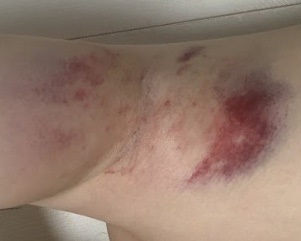 ミラドライ治療直後